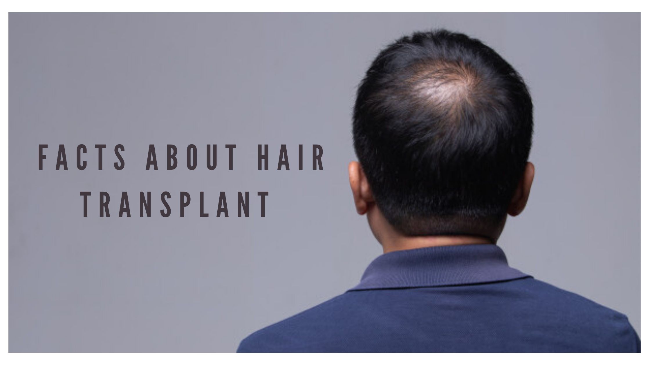 Hair Transplant: Know the Facts