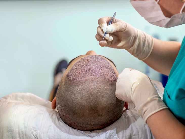 Hair Transplant Surgeon in Kolkata
