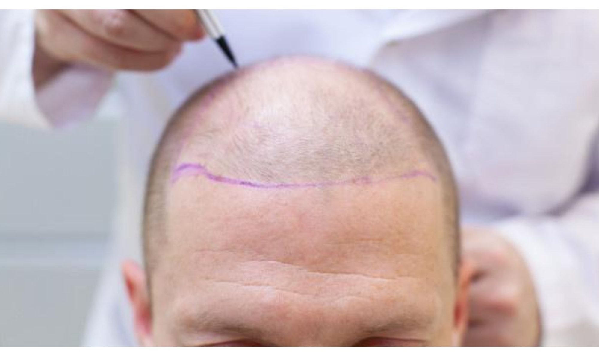 best hair trasnplant doctor in India banner