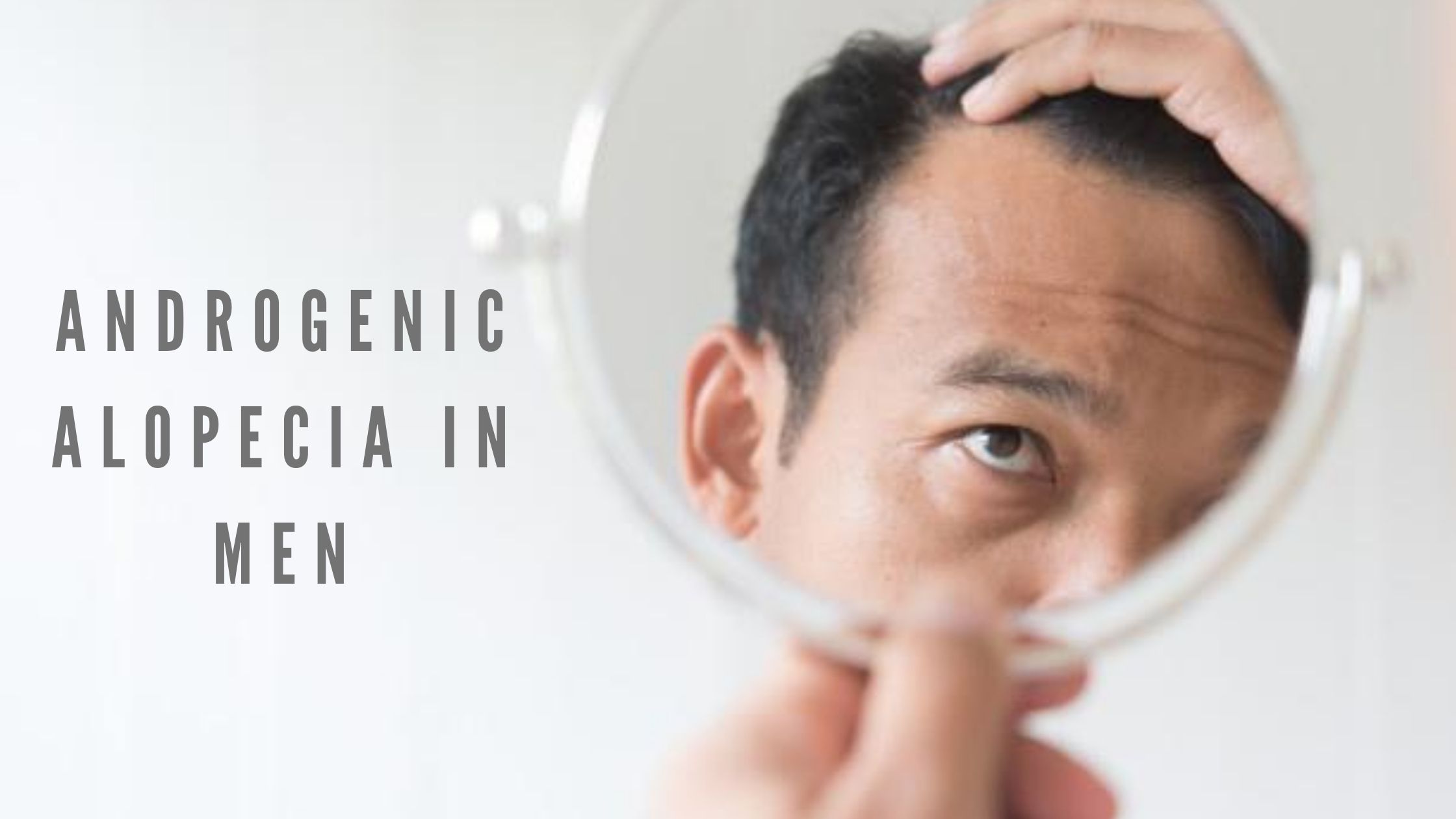 Androgenic alopecia in men