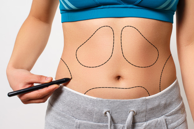 Difference between Abdominoplasty and Tummy Tuck
