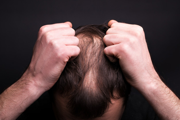 Types of Hair Loss Problems in Men | Dr . Rathore