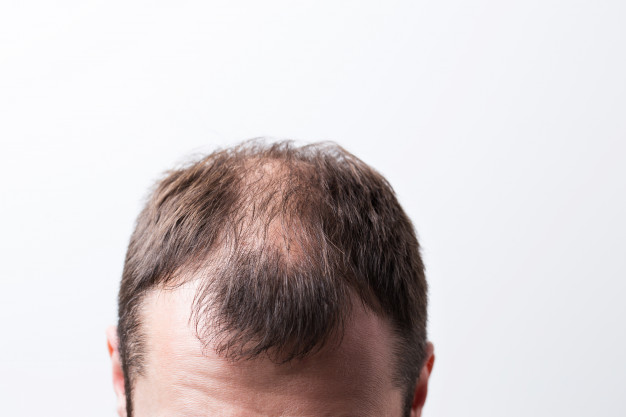 Premature Balding: Why Do Teenagers Get Bald? . Rathore