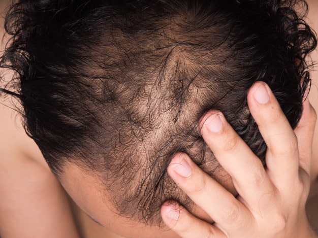 There are various methods of hair transplant. Follicular unit extraction is one of them. Follicular Unit Extraction: How Does It Work?