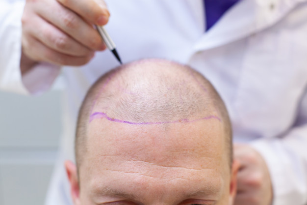 Regain Your Youth With The Best Hair Transplant Clinic In Kolkata