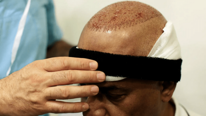 Does Sweating Affect Hair Transplant?