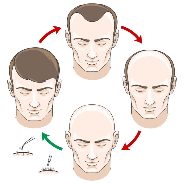 DOES HAIR TRANSPLANT LOOK NATURAL?