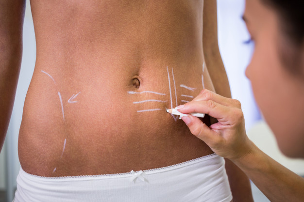 Liposuction: the new weight-loss trend