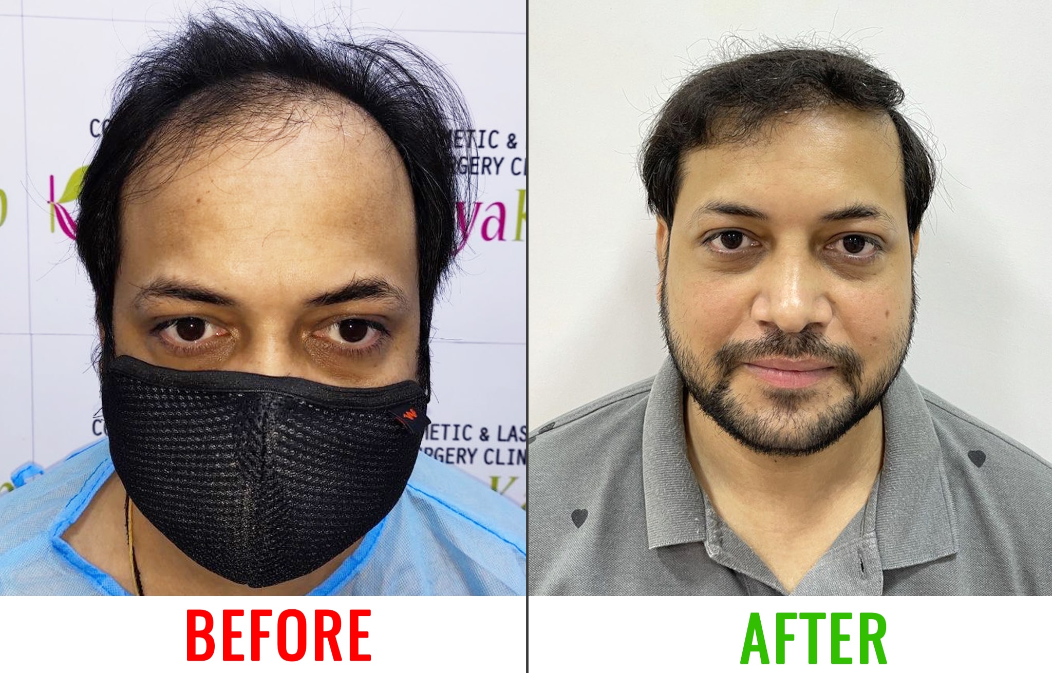 Hair Transplant in kolkata - Dr V S Rathore