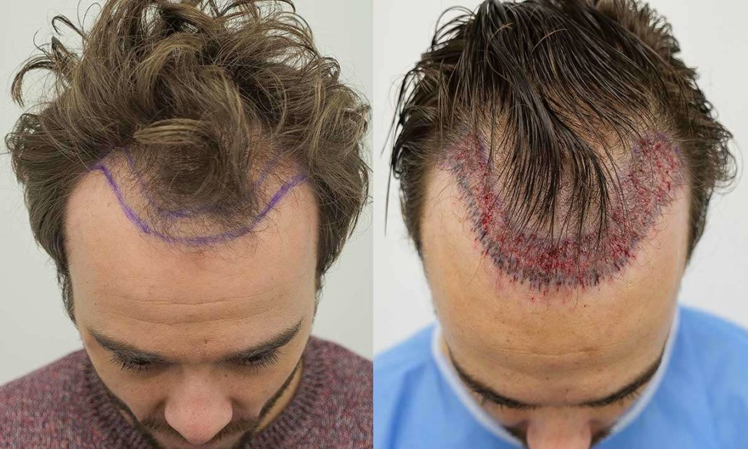 Is Hair Transplant Safe and Permanent | Dr. . Rathore