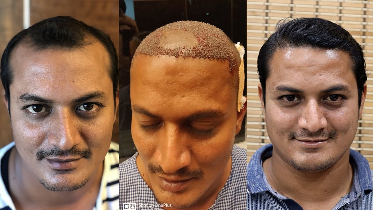 Major Facts About Hair Transplant You Need To Know