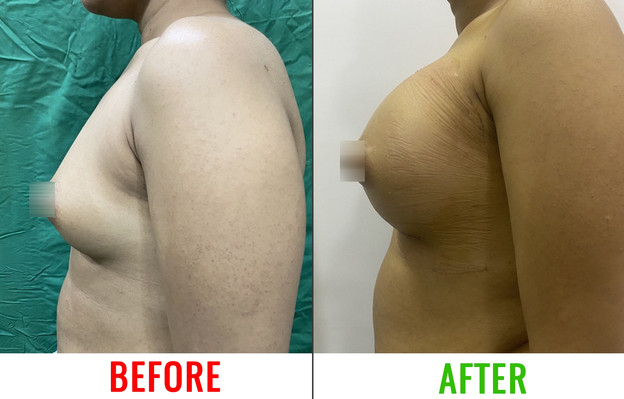Breast Implant Surgery in India .How to increase female boobs size 