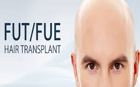 Hair Transplant : Is FUT More Effective than FUE?