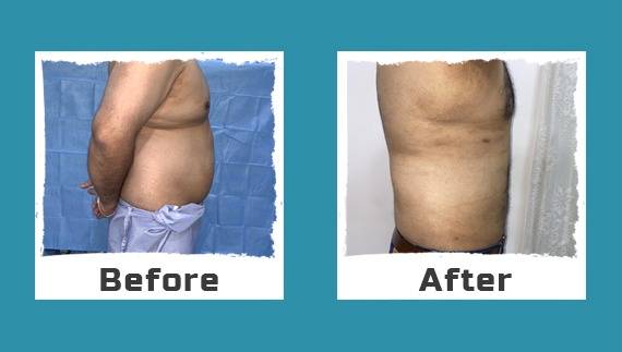 Difference between Tummy Tuck and Liposuction