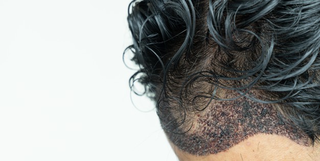 What are your Options when it Comes to Hair Transplant?