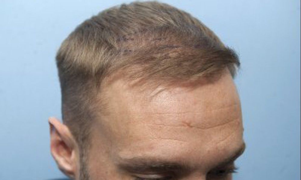 Second Hair Transplant – When Is It Required?