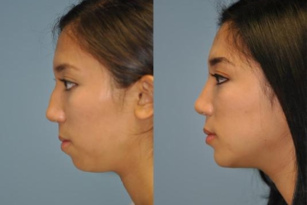 Ask these questions before undergoing a Chin Augmentation