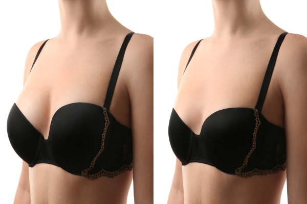 Breast Reduction Surgery Pros and Cons