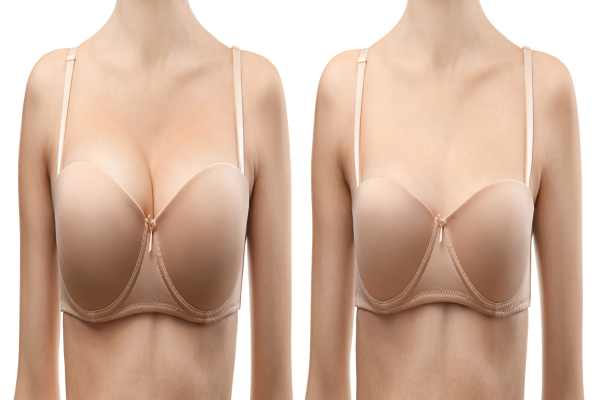 breast reduction surgery1