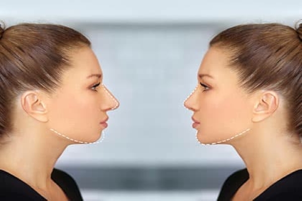All you need to know about Chin Surgery in Kolkata
