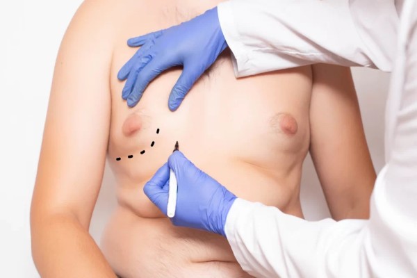 What Is Gynecomastia And What Causes It?