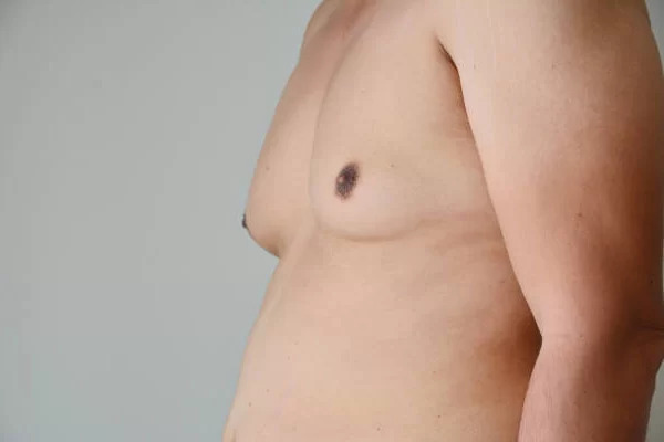 A List Of FAQs About Gynecomastia