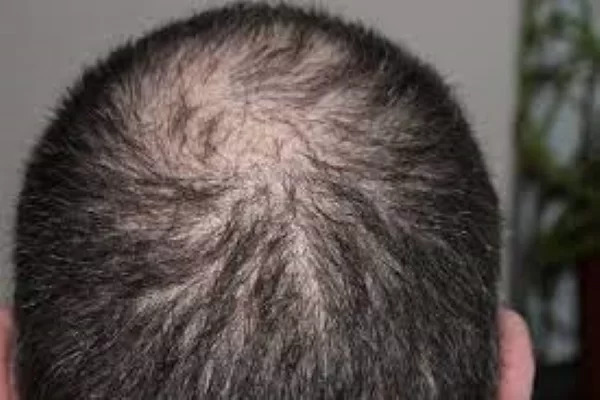 Hair transplant benefits