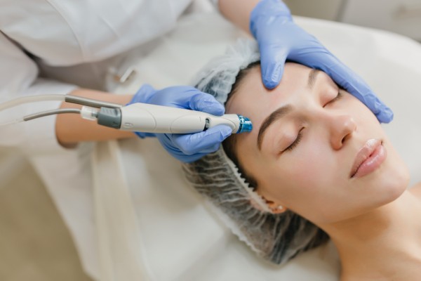 How Radiofrequency Microneedling Can Treat Your Acne Scars?