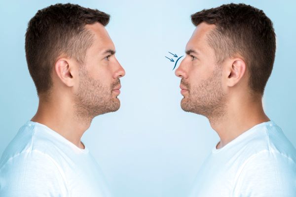 Elevate Your Beauty With The Art Of Rhinoplasty In Kolkata