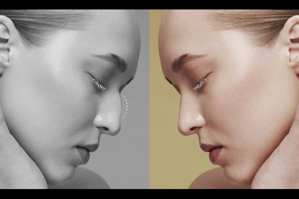 A picture of a woman showing the nose shape before and after Rhinoplasty nose surgery