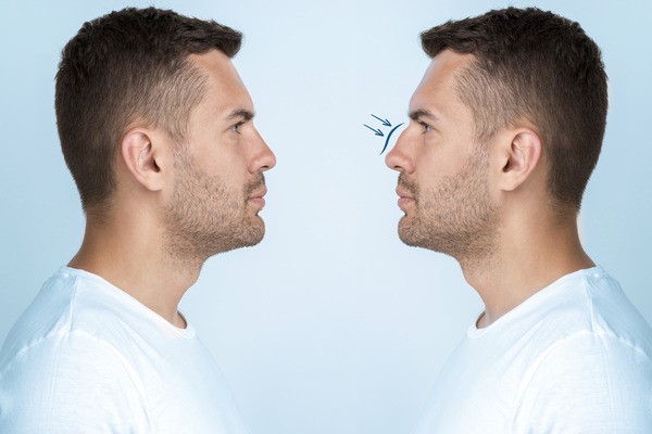 About Rhinoplasty: What to Expect from a Nose Job in Kolkata