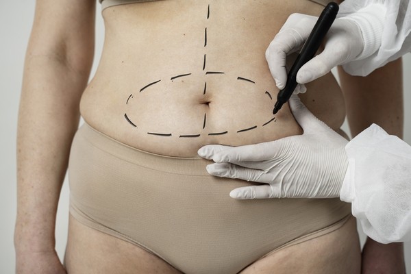 Tummy Tuck Cost in Kolkata pre-surgery marking scene